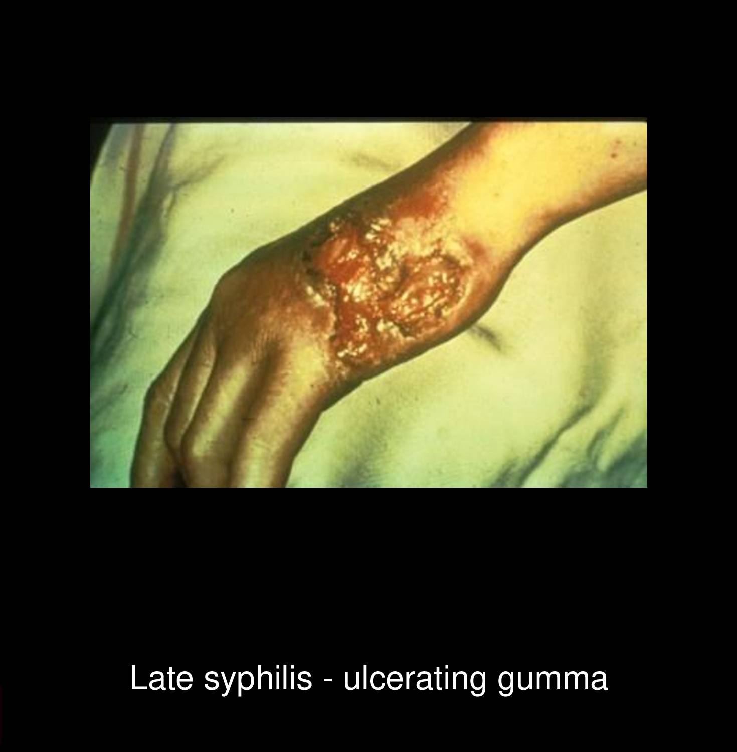 Tertiary syphilis nodular lesion on face showing destructive granulomatous gumma with ulceration and crusting caused by Treponema pallidum